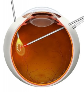Retinal tears found at time of FOV (vitrectomy) are treated with laser.