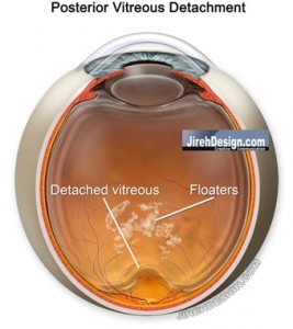 PVD or posterior vitreous detachment, Randall Wong, M.D., Retina Specialist, Fairfax, Virginia