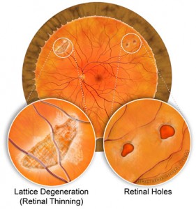 Lattice Degeneration, Retinal Holes and Retinal Tears